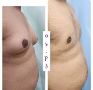 Before and after of a Gynecomastia surgery Ahmedabad by Dr Priyanka Sharma