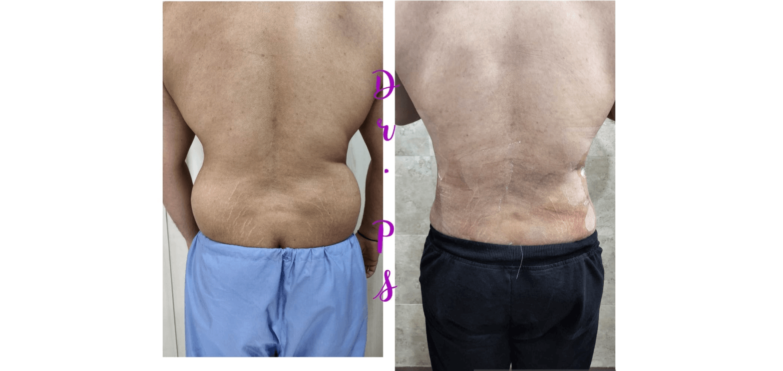 Before and after a Liposuction surgery in Ahmedabad by Dr priyanka sharma