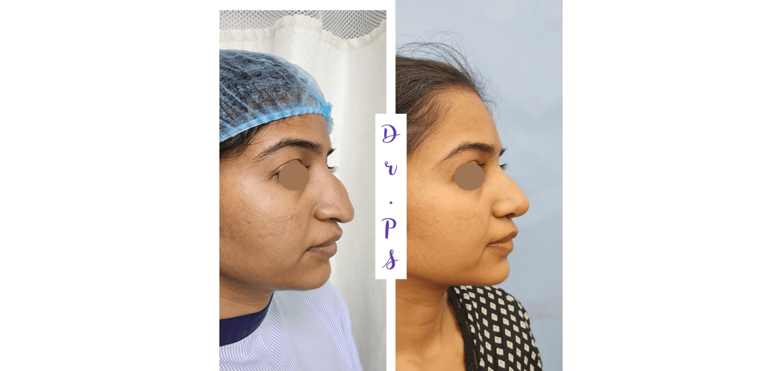 Before and after a Rhinoplasty surgery by Dr priyanka sharma