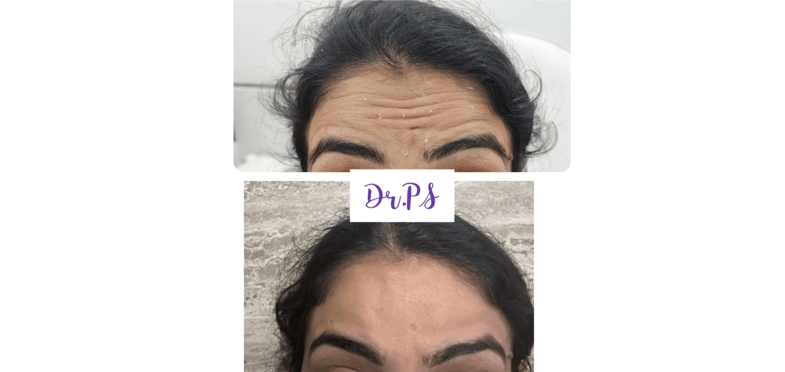 Botox fillers in Ahmedabad by DR Priyanka Sharma