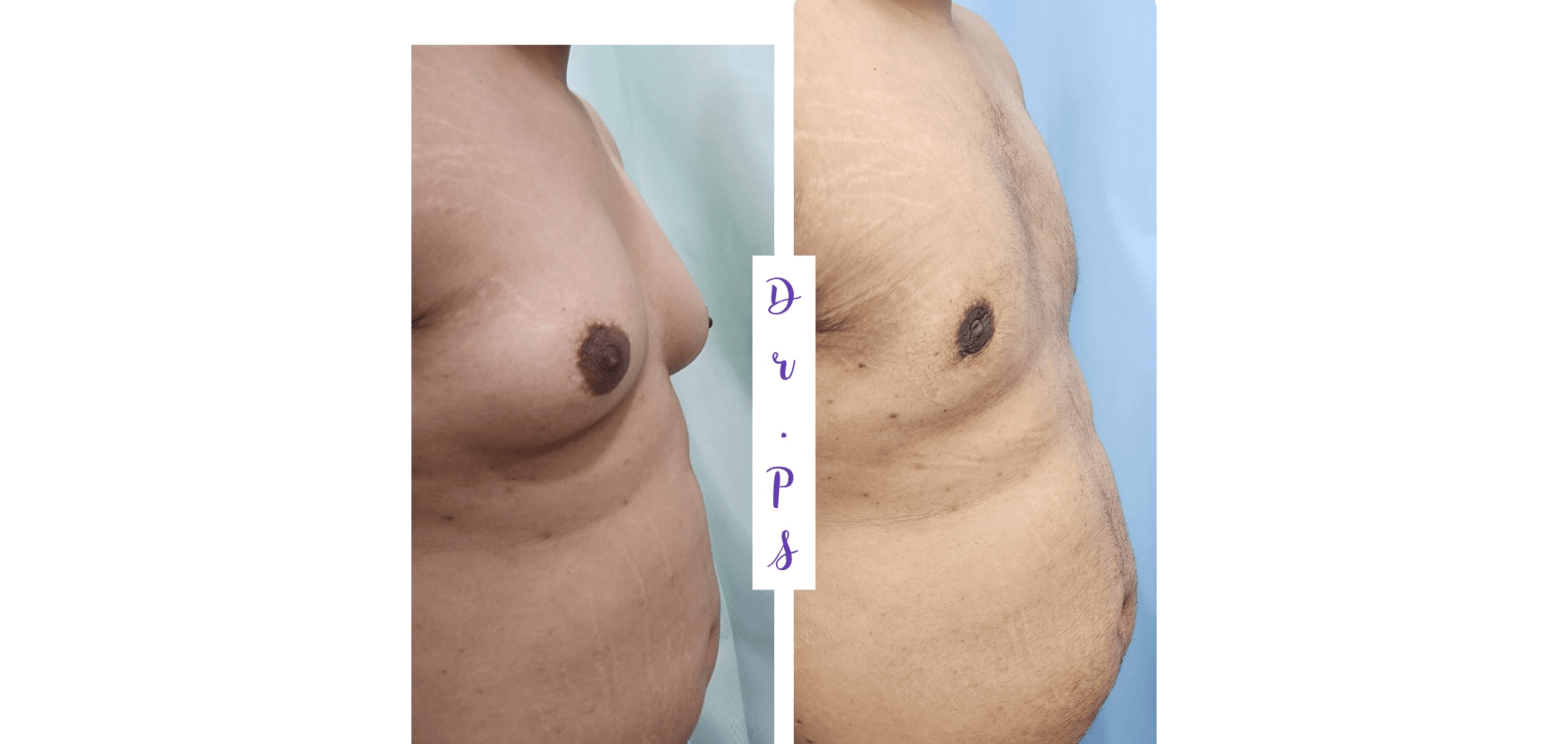 Before and after a Gynecomastia surgery in Ahmedabad by Dr priyanka sharma