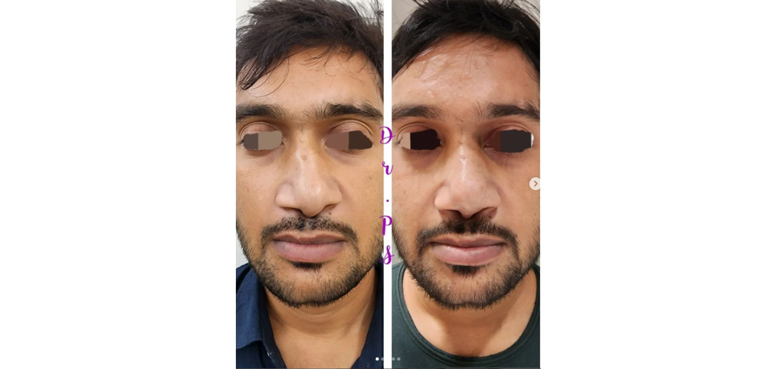 Before and after a nose surgery by Dr. PS - Dr. Priyanka Sharma in Ahmedabad