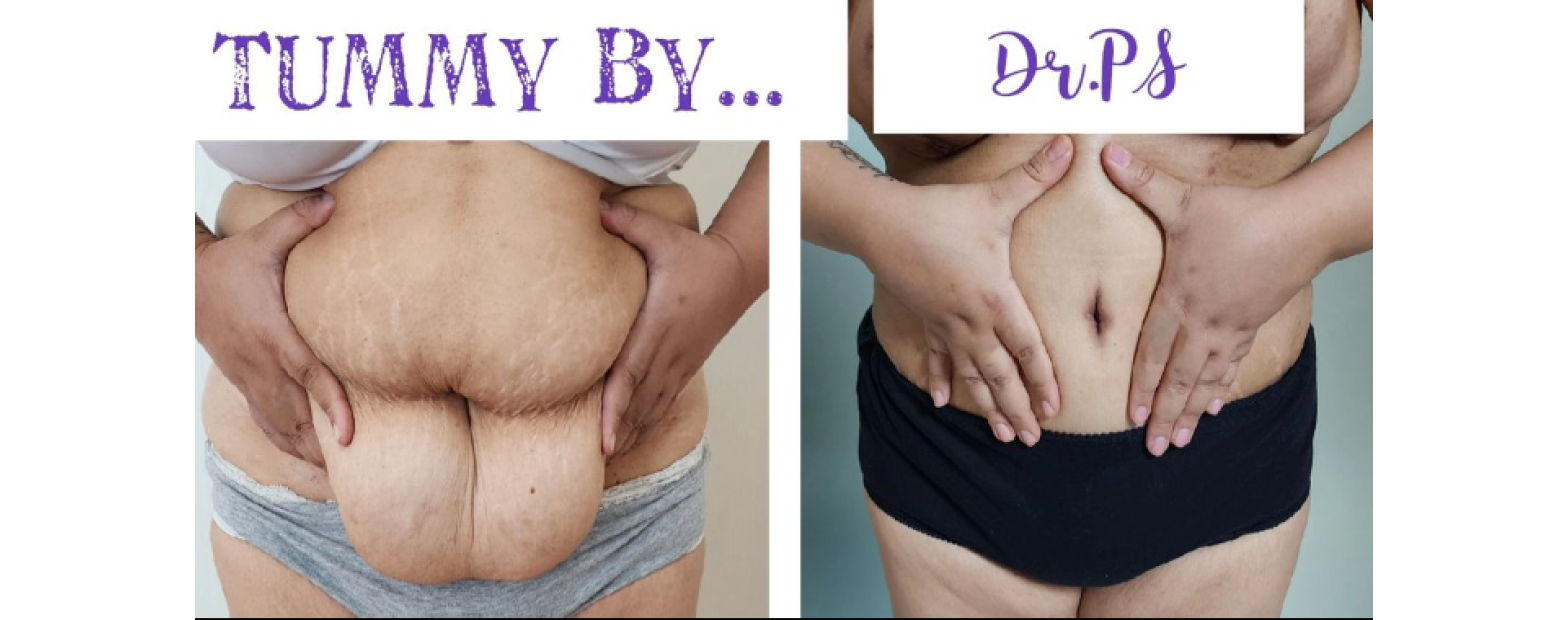 Tummy tuck surgery by Dr Priyanka Sharma