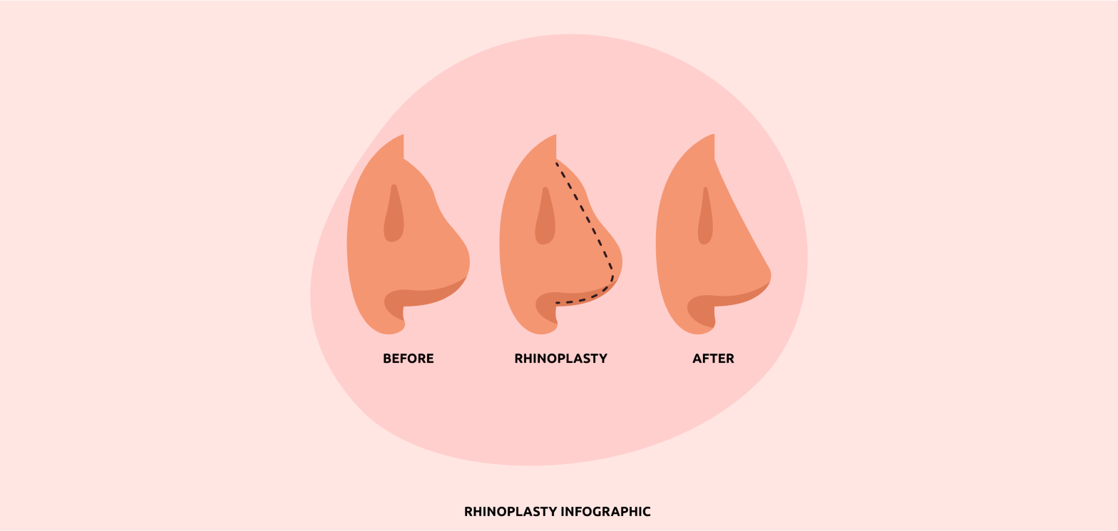 Understanding the Recovery Process After Rhinoplasty Surgery