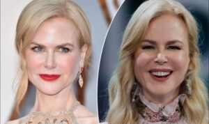 Face fillers before and after