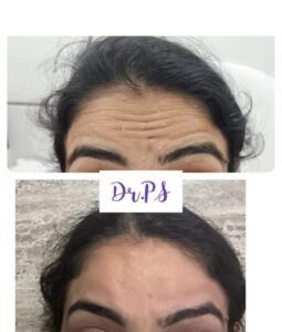 Before and after Botox treatment on forehead in Ahmedabad