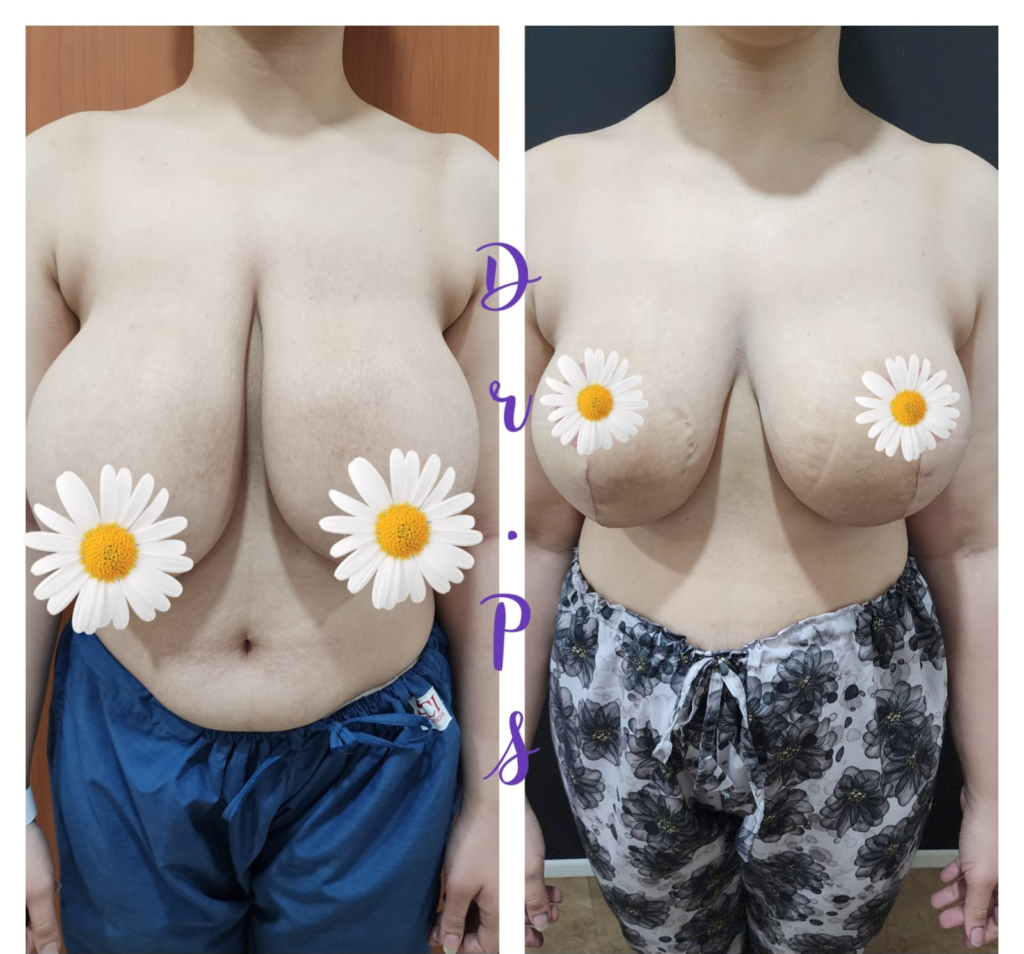 Breast reduction surgery in ahmedabad
