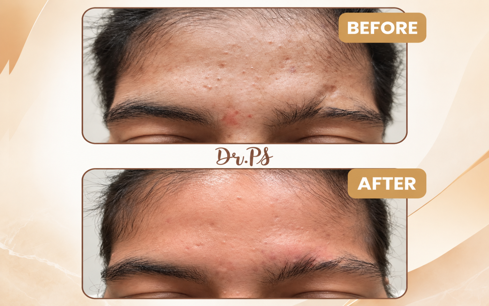 Scar Revision Surgery: What It Can and Cannot Change