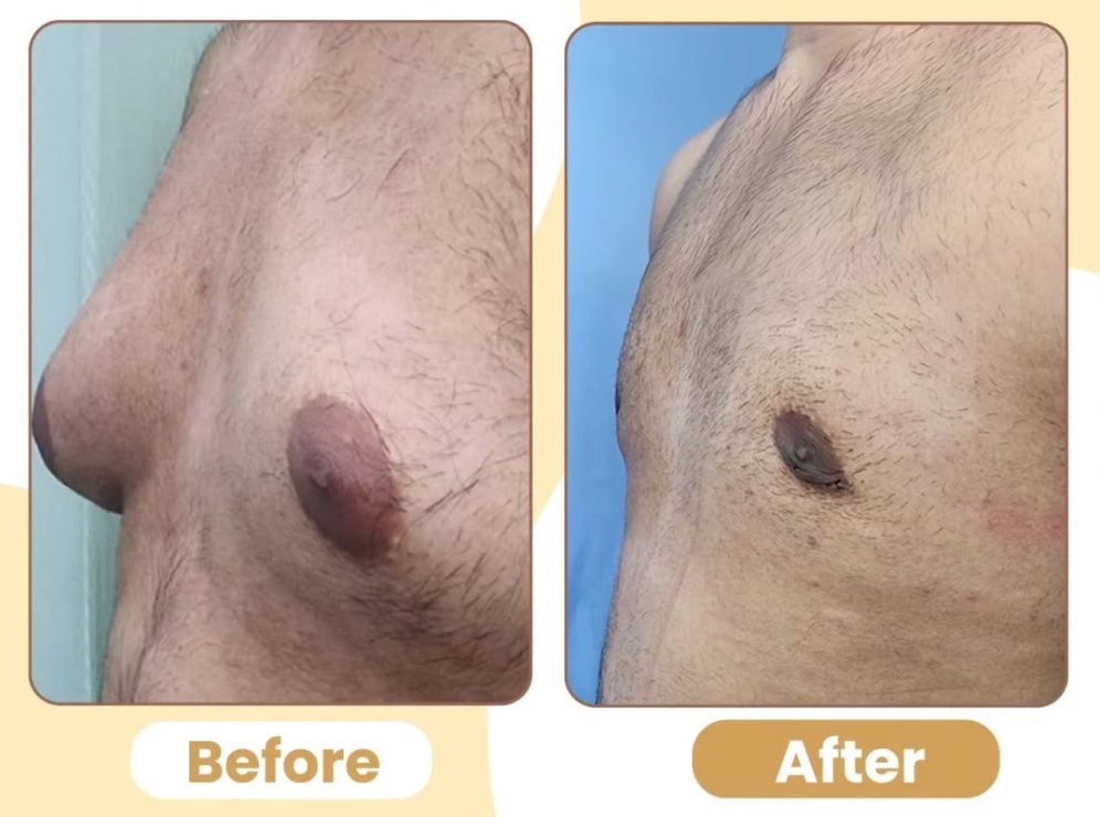 Close-up before and after showing a protruding areola flattened after gynecomastia surgery