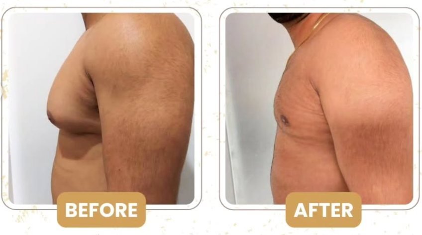 Side view before and after gynecomastia surgery showing a flatter male chest contour