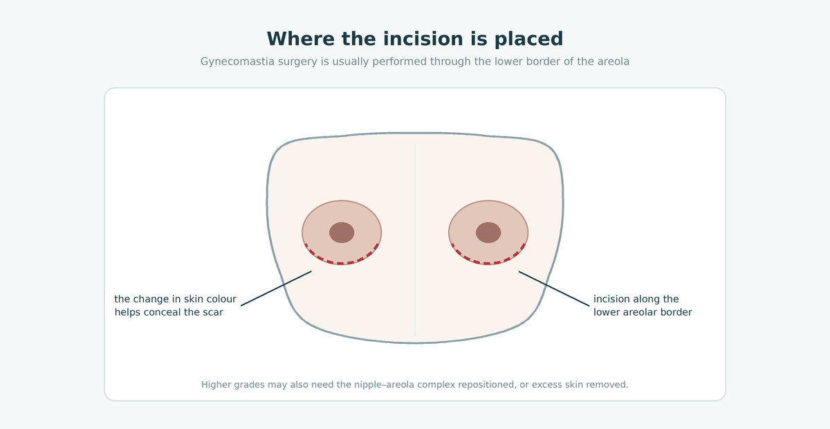 Diagram showing the gynecomastia surgery incision placed along the lower border of the areola
