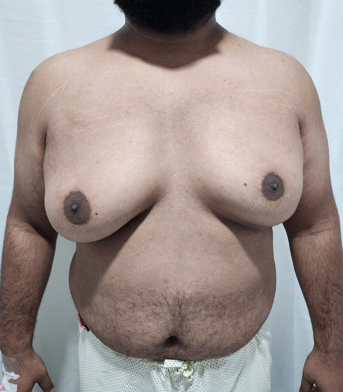 Male chest enlargement that could be gynecomastia or chest fat