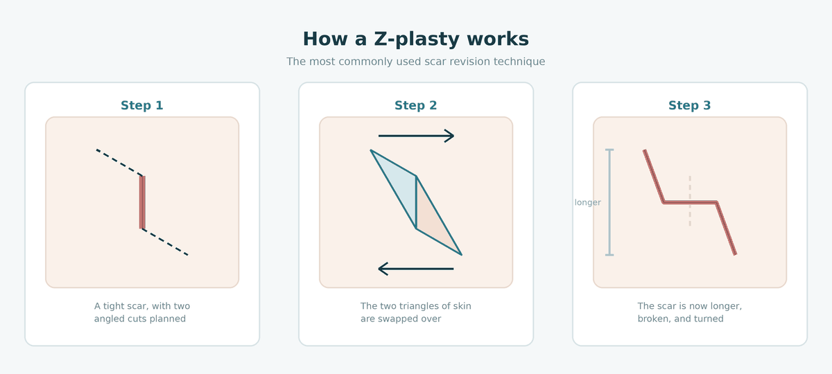 Three-step diagram showing how a Z-plasty lengthens, breaks up and turns a scar