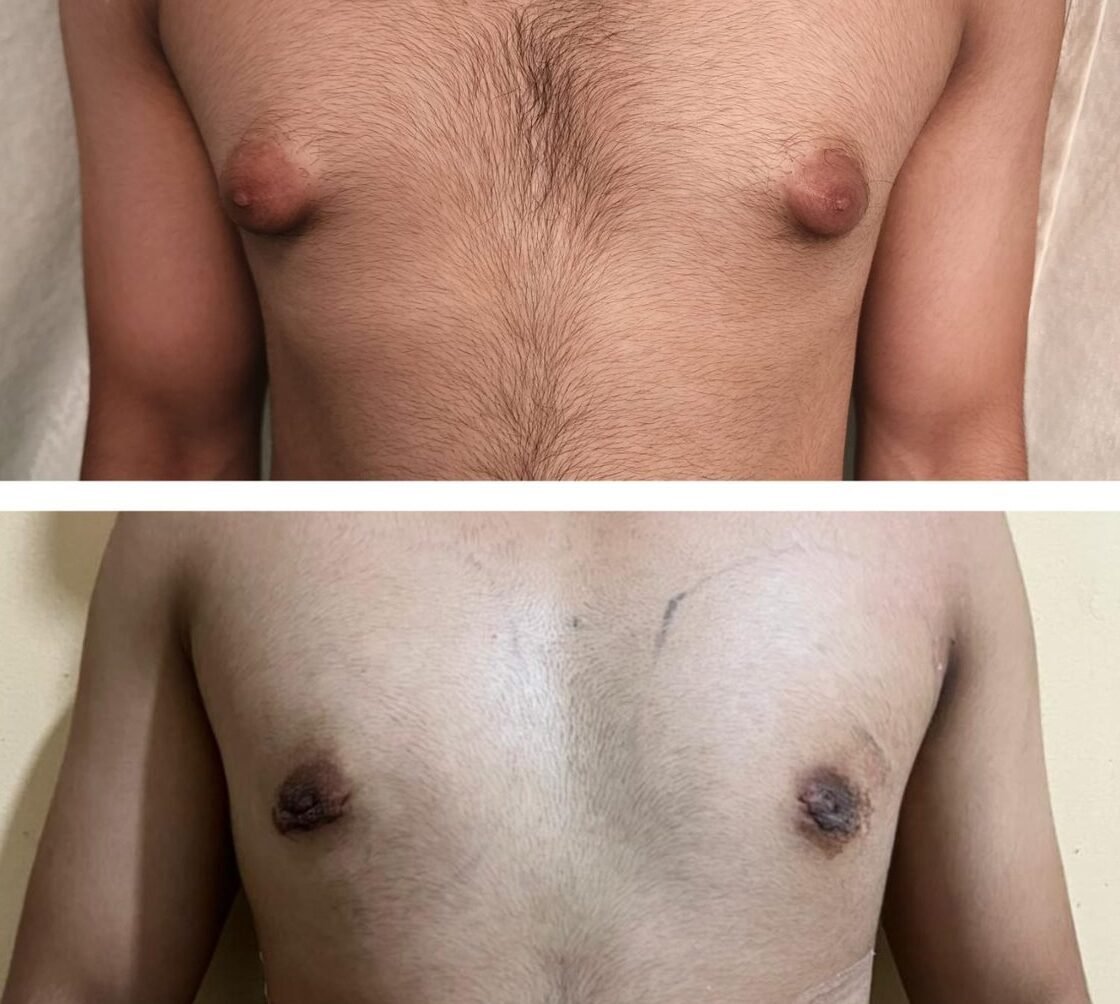 Male chest enlargement that could be gynecomastia or chest fat