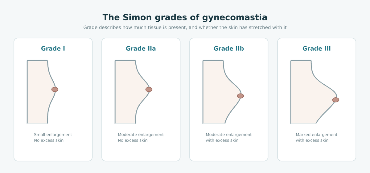 Diagram of the Simon classification grades I, IIa, IIb and III of gynecomastia