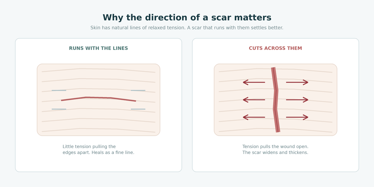 Diagram comparing a scar running with the skin’s relaxed tension lines and one cutting across them