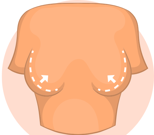 Breast Reduction Surgery in Ahmedabad