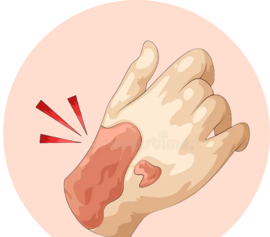 Burns Treatment in Ahmedabad