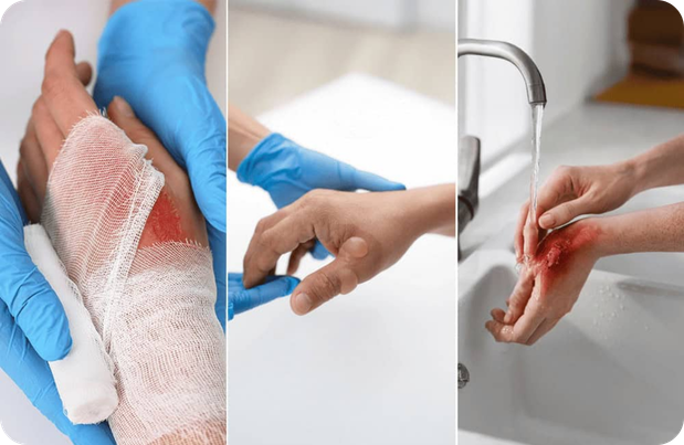 Burns Treatment Suitability
