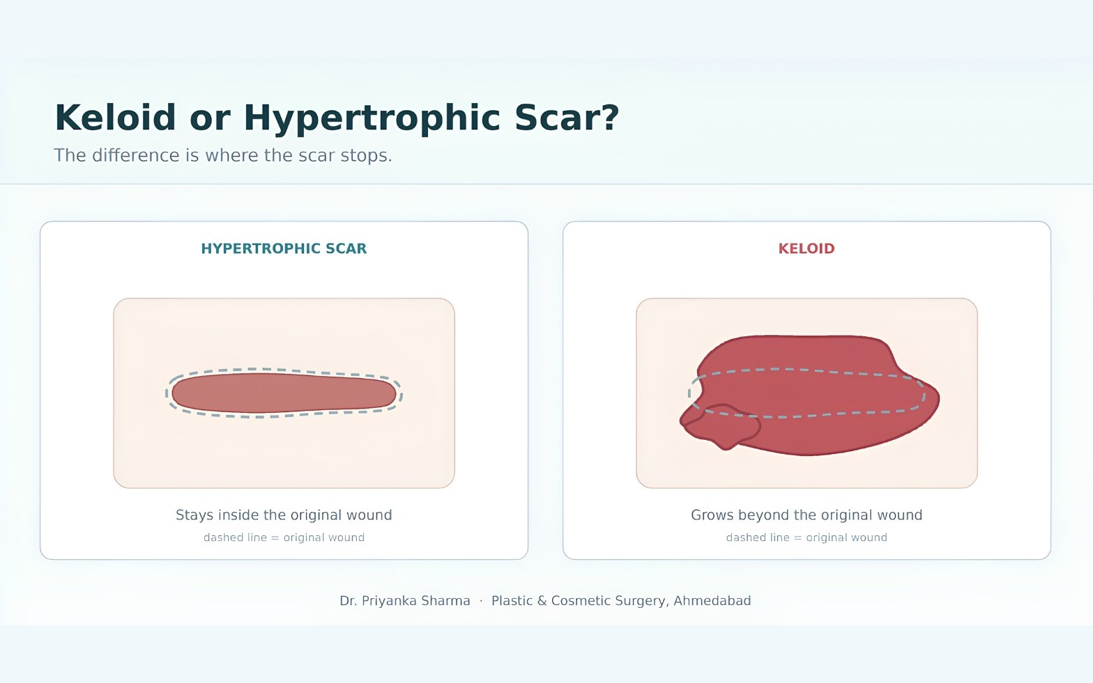 Keloid or Hypertrophic Scar? How to Tell the Difference